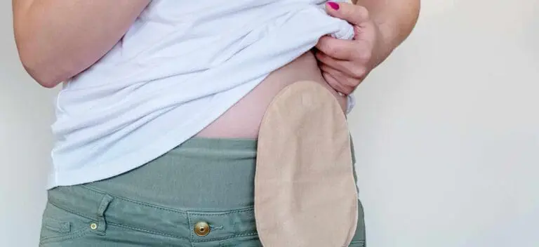 Saiba para quem são indicadas as cirurgias de colostomia e ileostomia, tratamentos que auxiliam no manejo de doenças intestinais graves e suas complicações.